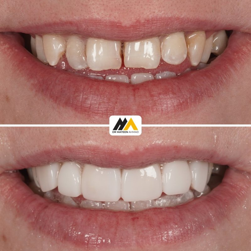 Composite bonding full smile rebuild before and after, Dr Mateen Ahmad, Synergy Dental Clinic Oldham