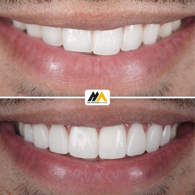Composite bonding smile makeover before and after by Dr Mateen Ahmad, cosmetic dentist Oldham