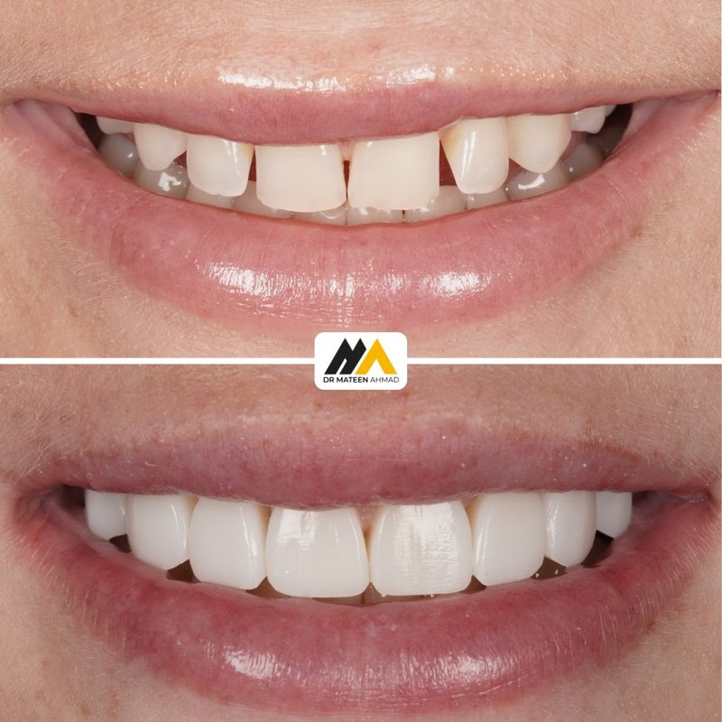 Composite bonding for spacing and alignment, before and after, Dr Mateen Ahmad, Oldham