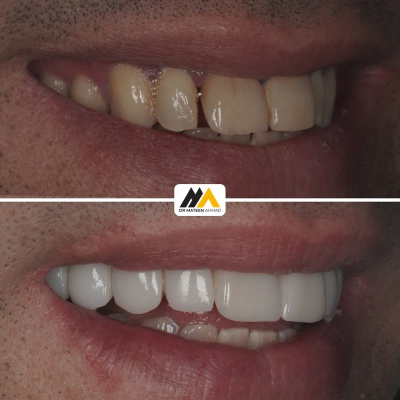 Indirect composite veneers, colour and shape correction before and after, Dr Mateen Ahmad, Oldham